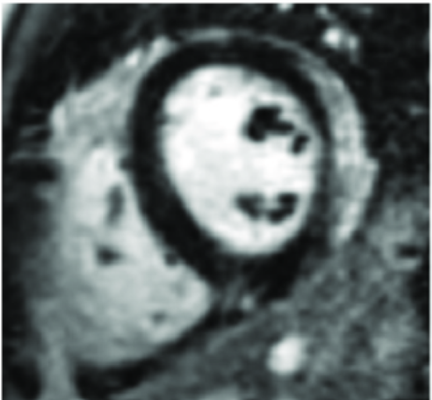 MYOCARDIA