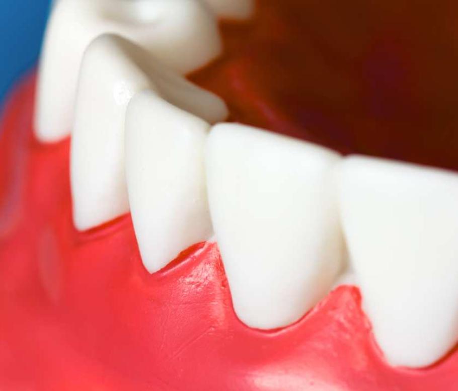dents